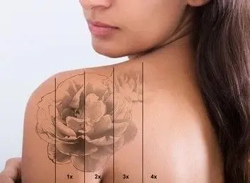3d-tattoo-removal