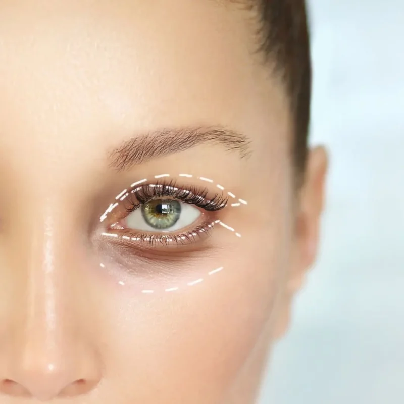 blepharoplasty-for-women