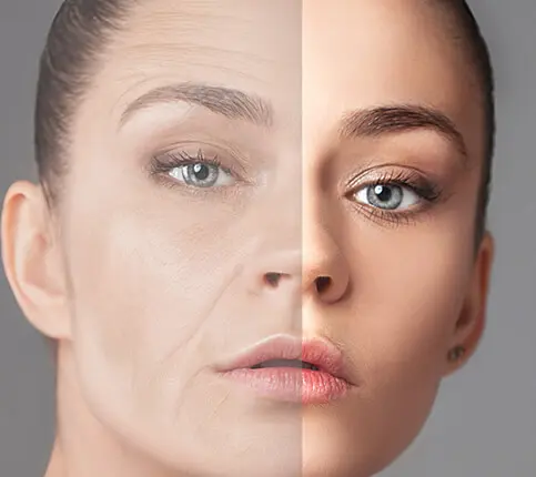 face-fat-grafting