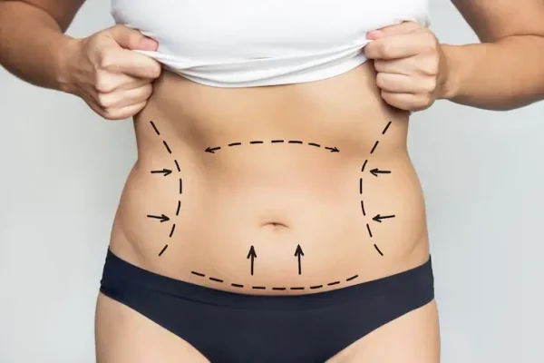 liposuction-in-dubai-treatment