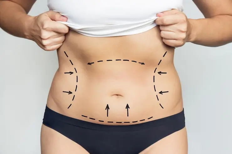 liposuction-in-dubai-treatment