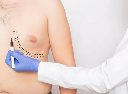 gynecomastia-surgery