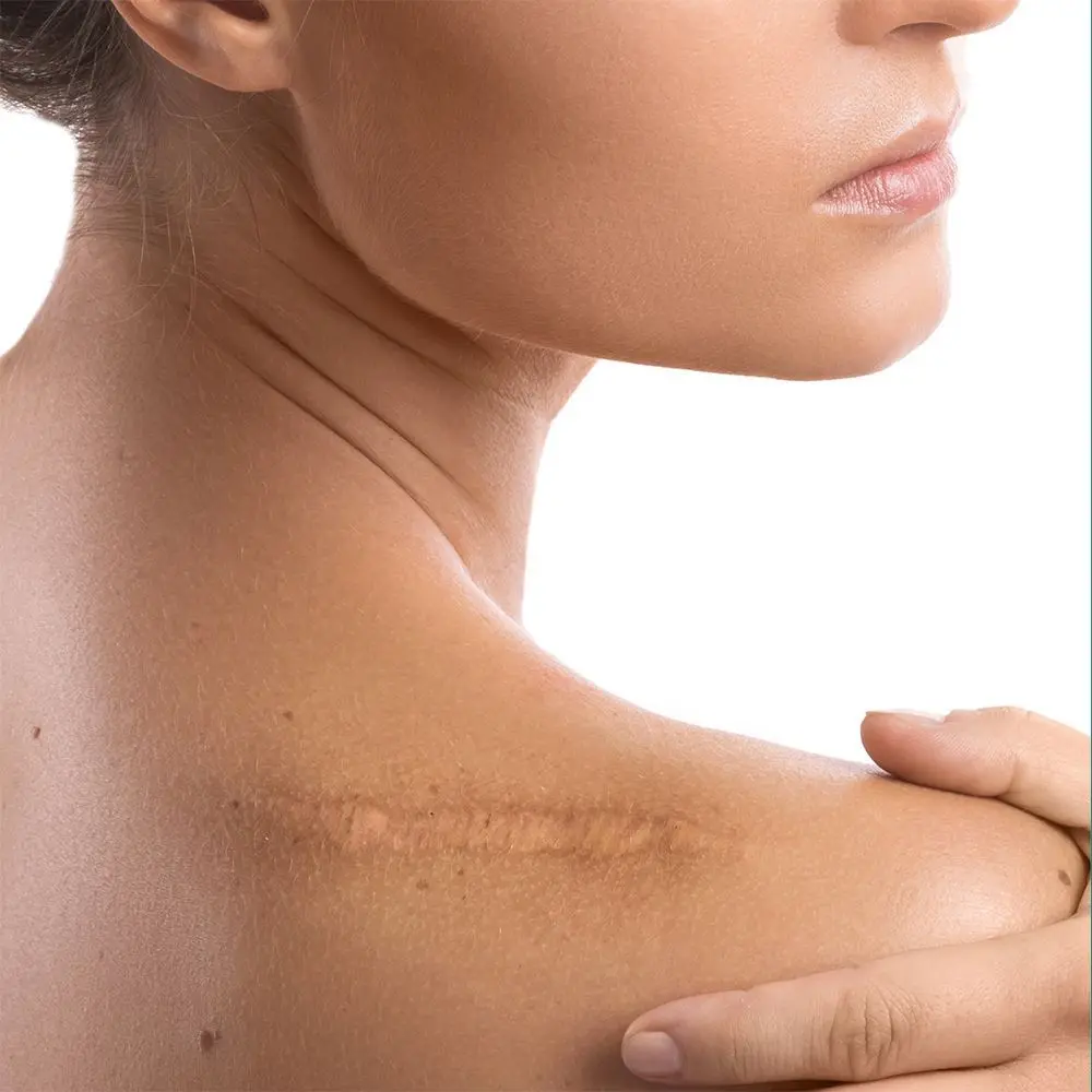 scar-revision-img