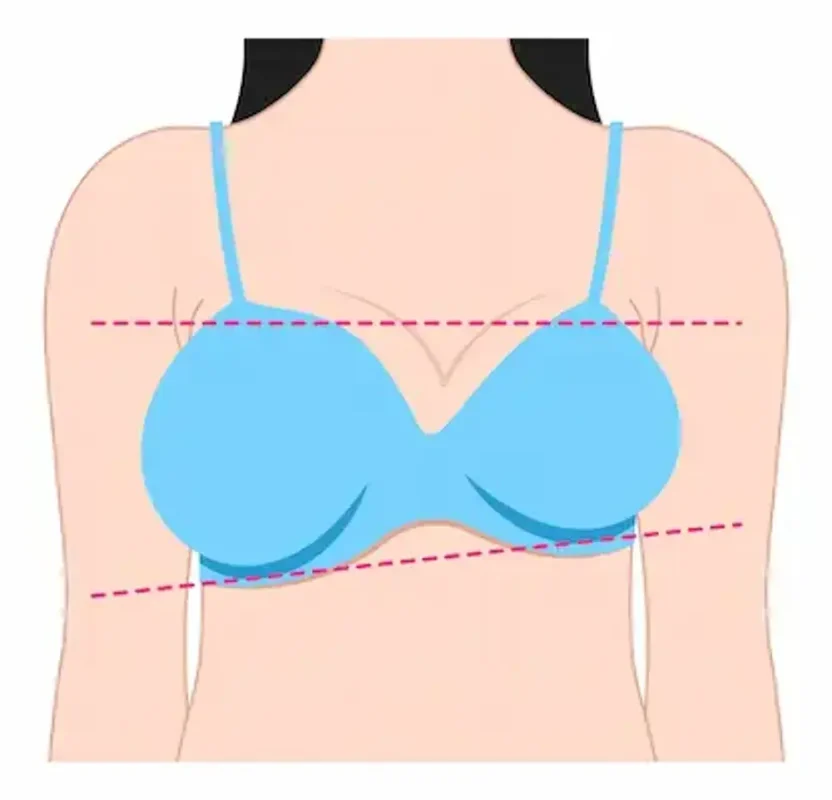 tuberous-breast-deformity