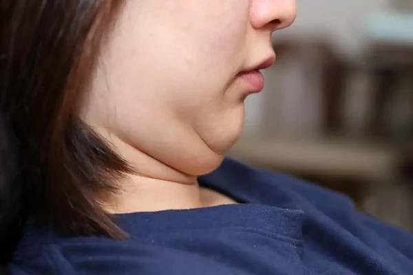 double-chin-treatment