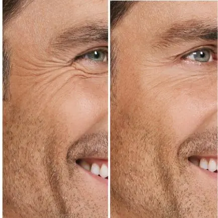 botox-vs-fillers-for-men