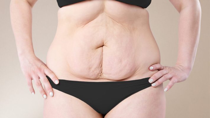 loose-skin-after-weight-loss