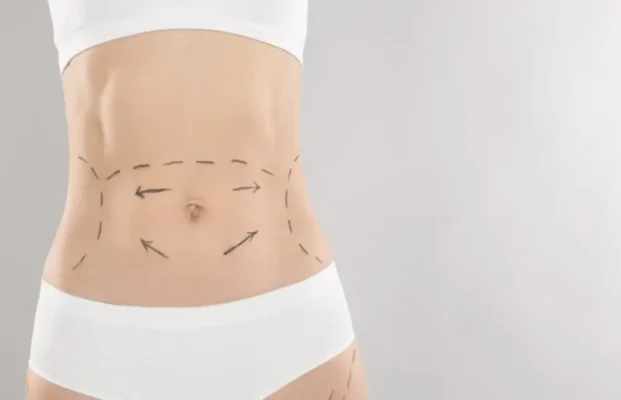 tummy-tuck-recovery