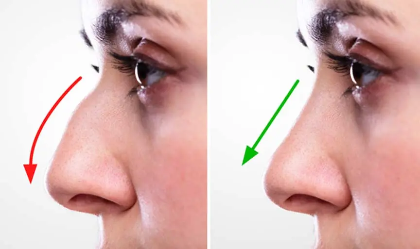 septoplasty-surgery