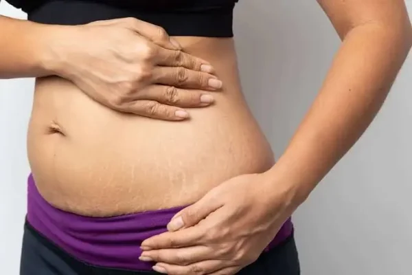 stretch-marks-treatment