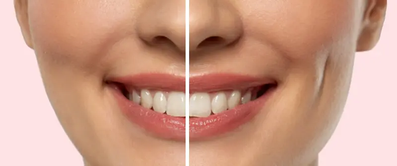 dimple-creation-surgery