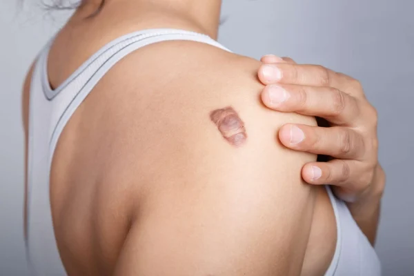 keloid-treatment-in-dubai