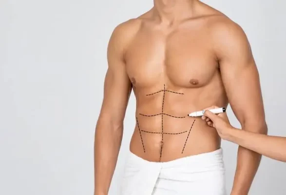 abdominoplasty-for-men