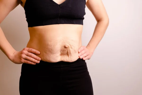 diastasis-recti-surgery